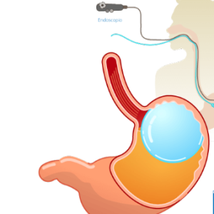 Programa de Tratamiento de Obesidad (Balón Intragástrico)